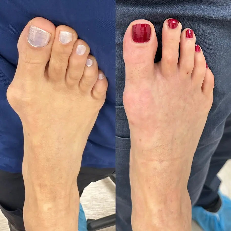 Bunion Corrector