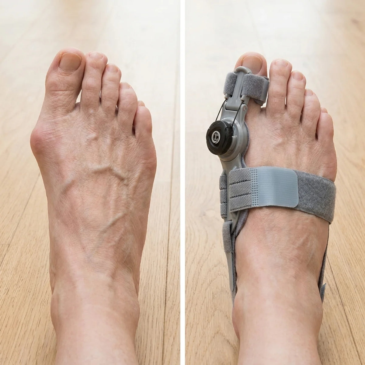 Bunion Corrector